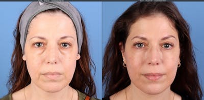 Eyelid Surgery (Upper & Lower Blepharoplasty) Before & After Gallery - Patient 308806 - Image 1