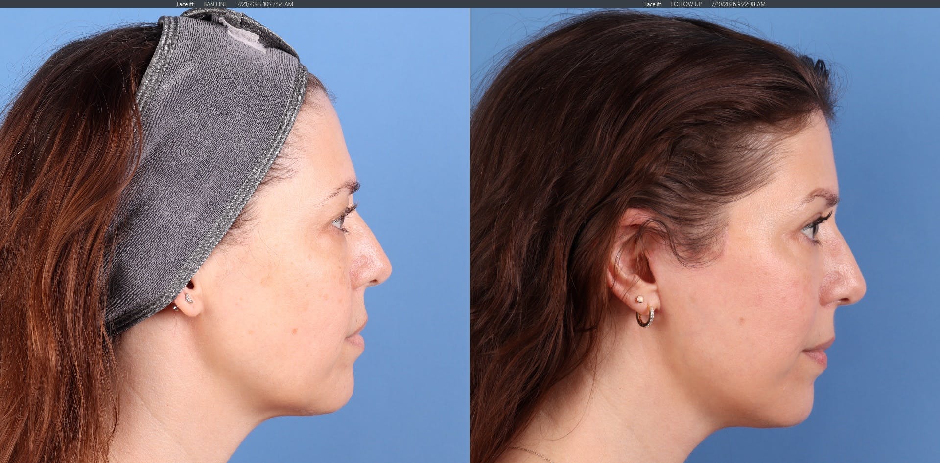 Eyelid Surgery (Upper & Lower Blepharoplasty) Before & After Gallery - Patient 308806 - Image 5