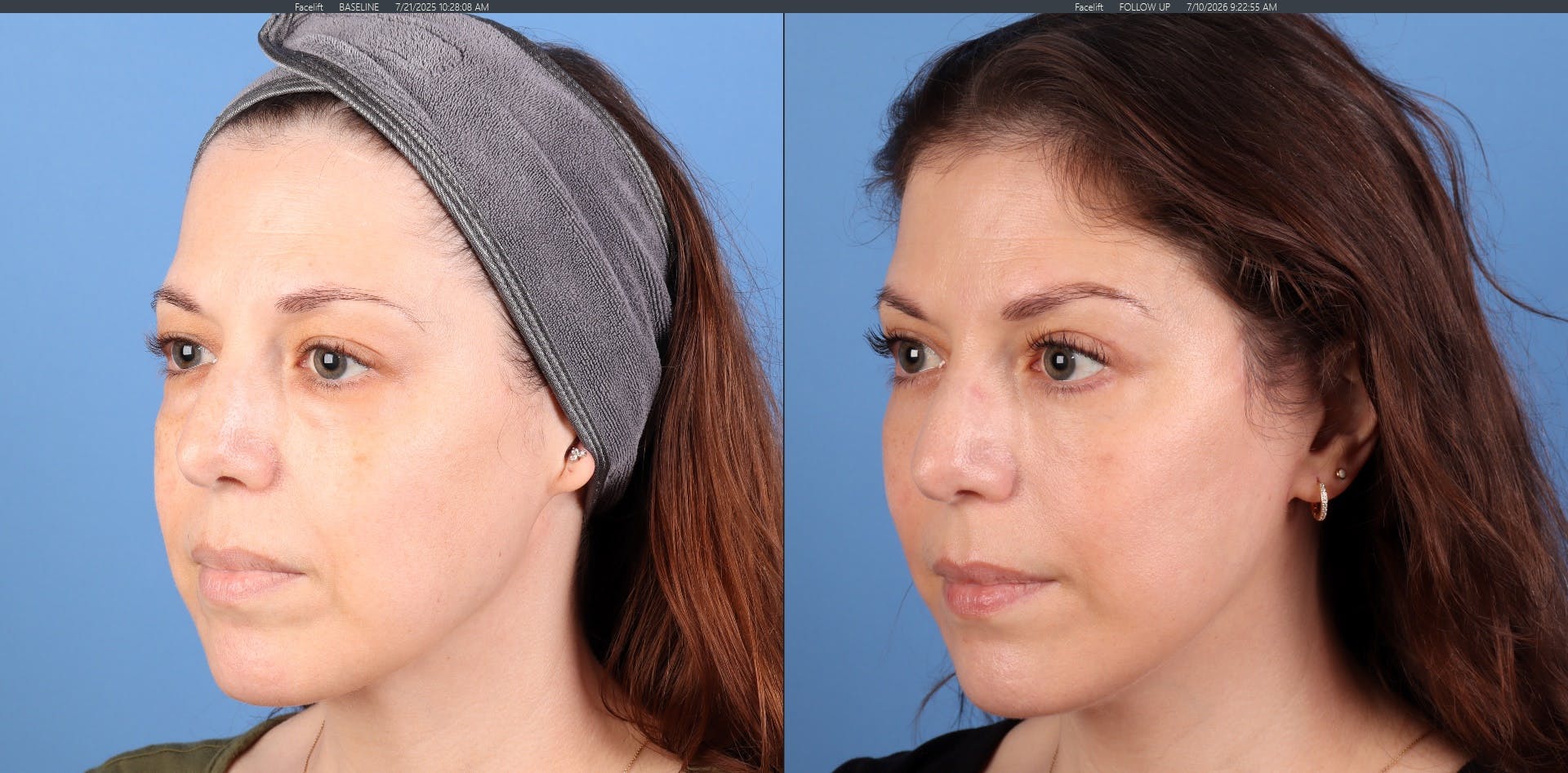 Eyelid Surgery (Upper & Lower Blepharoplasty) Before & After Gallery - Patient 308806 - Image 3