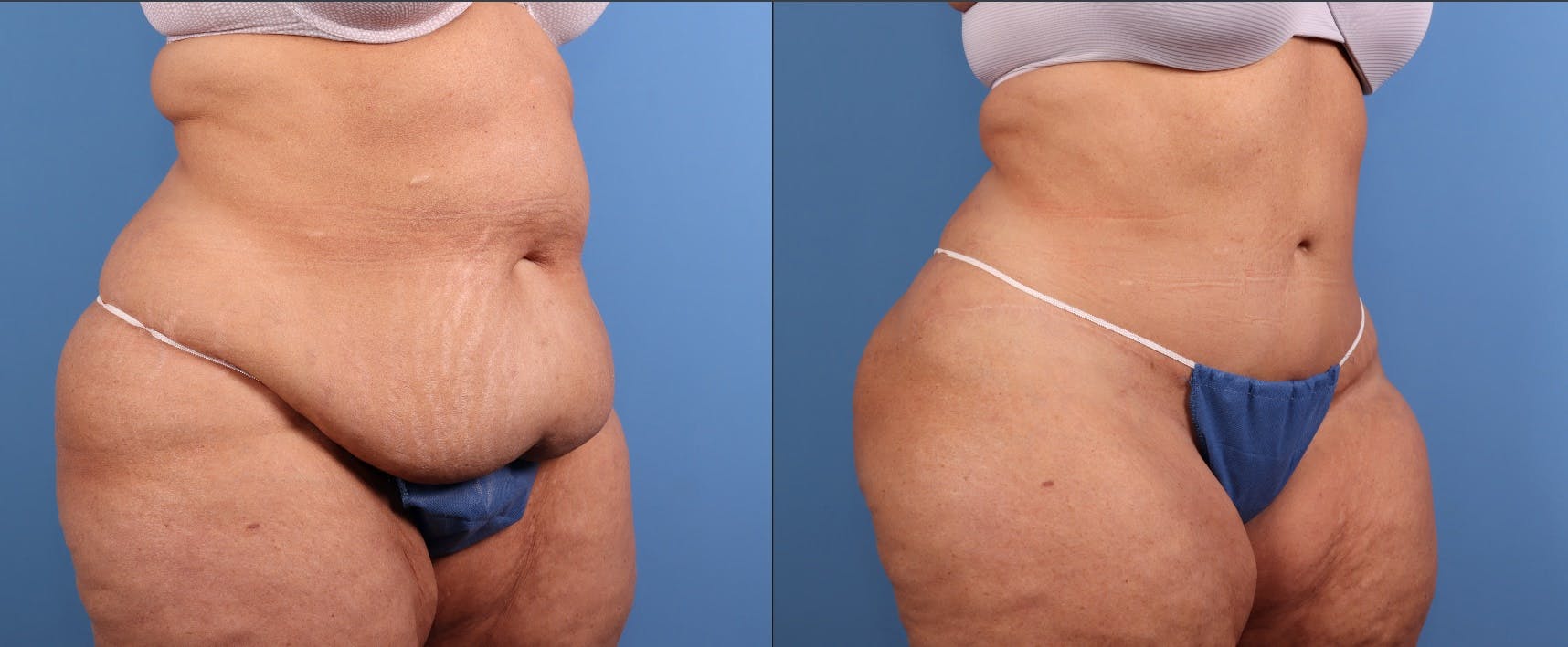 Tummy Tuck Before & After Gallery - Patient 335308 - Image 2