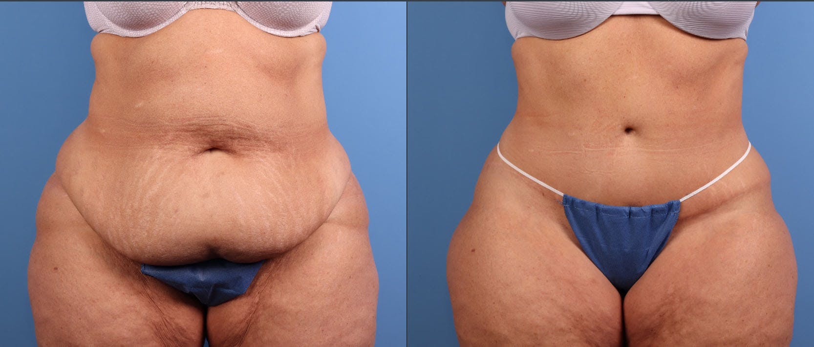 Tummy Tuck Before & After Gallery - Patient 335308 - Image 1