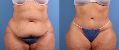 Tummy Tuck Before & After Gallery - Patient 335308 - Image 1