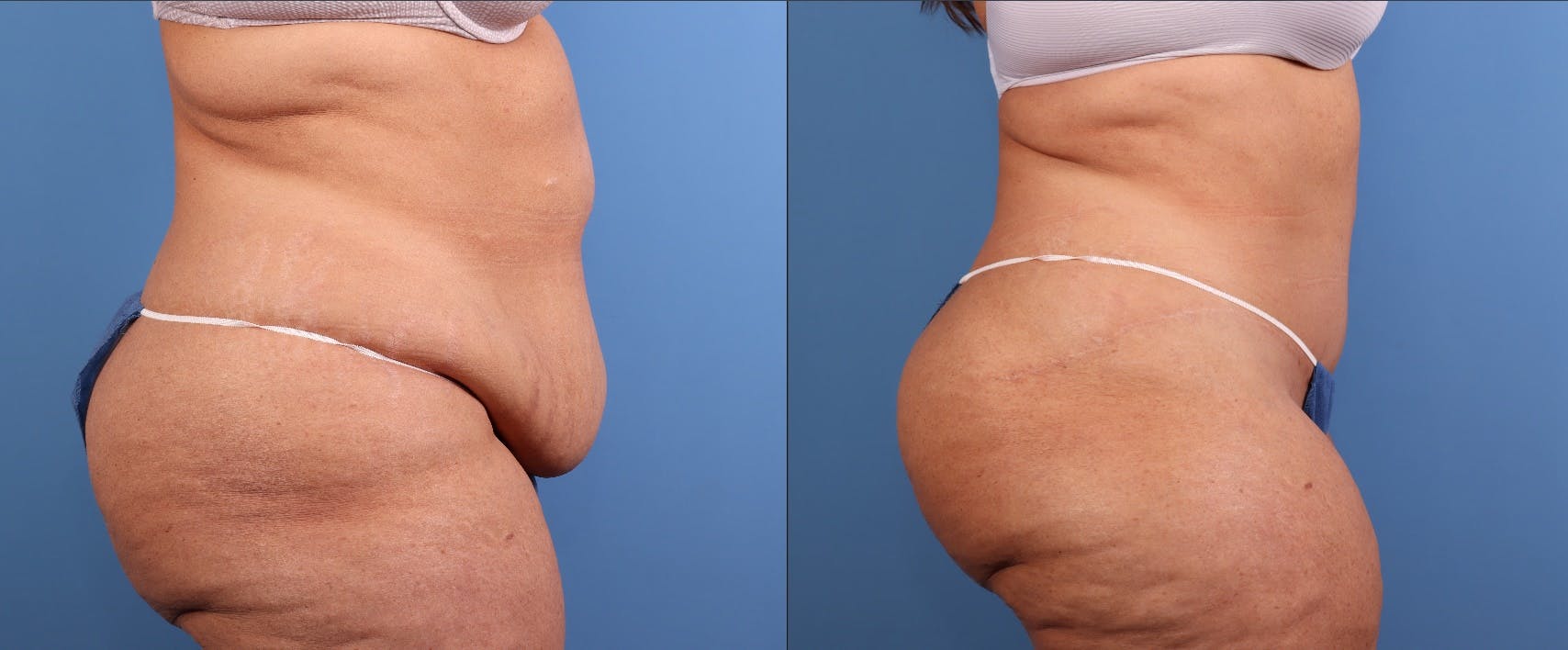 Tummy Tuck Before & After Gallery - Patient 335308 - Image 3