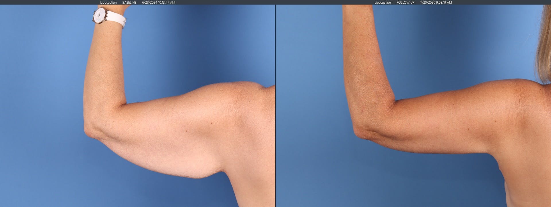 Arm Lift Before & After Gallery - Patient 312941 - Image 3