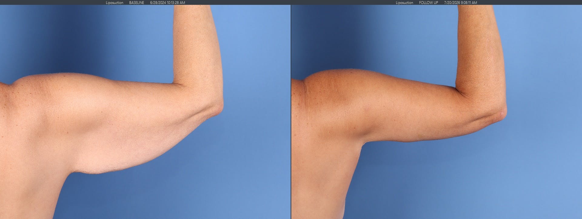 Arm Lift Before & After Gallery - Patient 312941 - Image 4