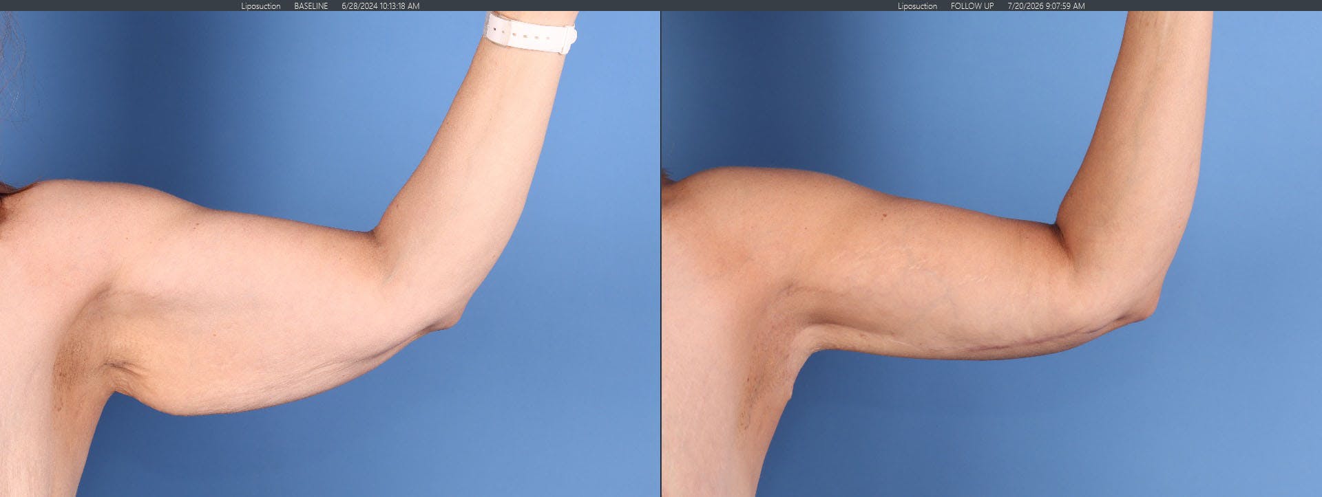 Arm Lift Before & After Gallery - Patient 312941 - Image 2