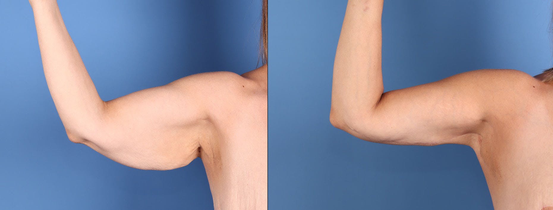 Arm Lift Before & After Gallery - Patient 312941 - Image 1