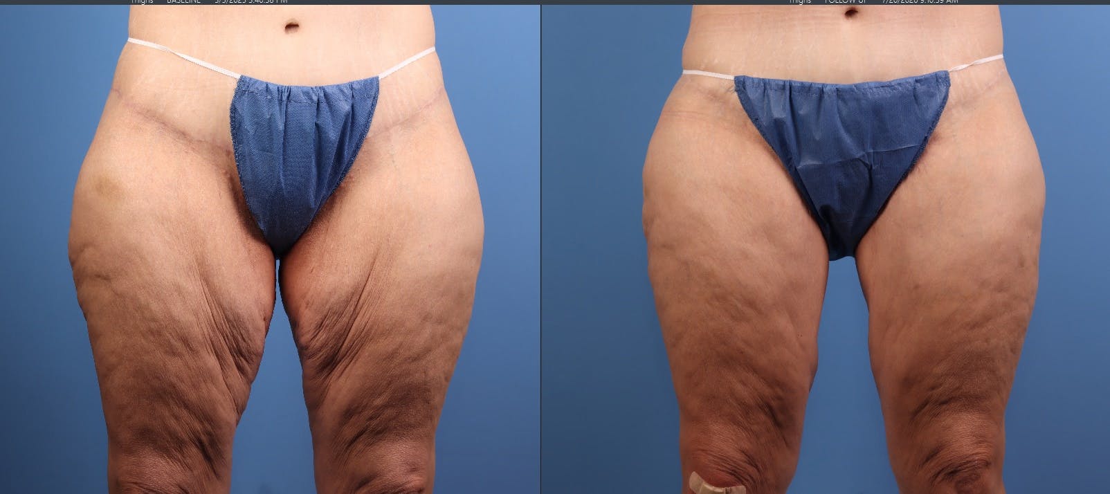 Thigh Lift Before & After Gallery - Patient 325856 - Image 1