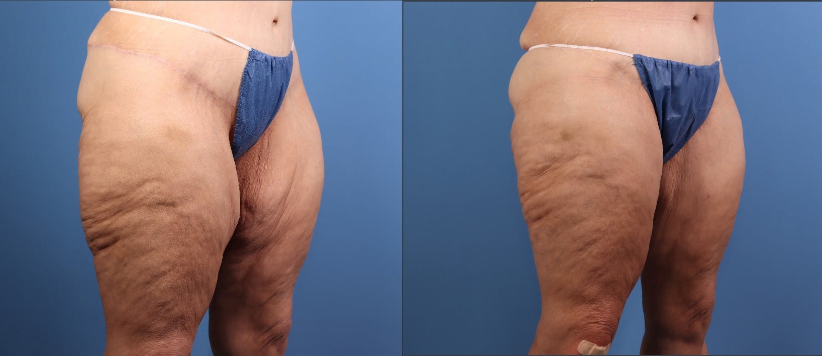 Thigh Lift Before & After Gallery - Patient 325856 - Image 2