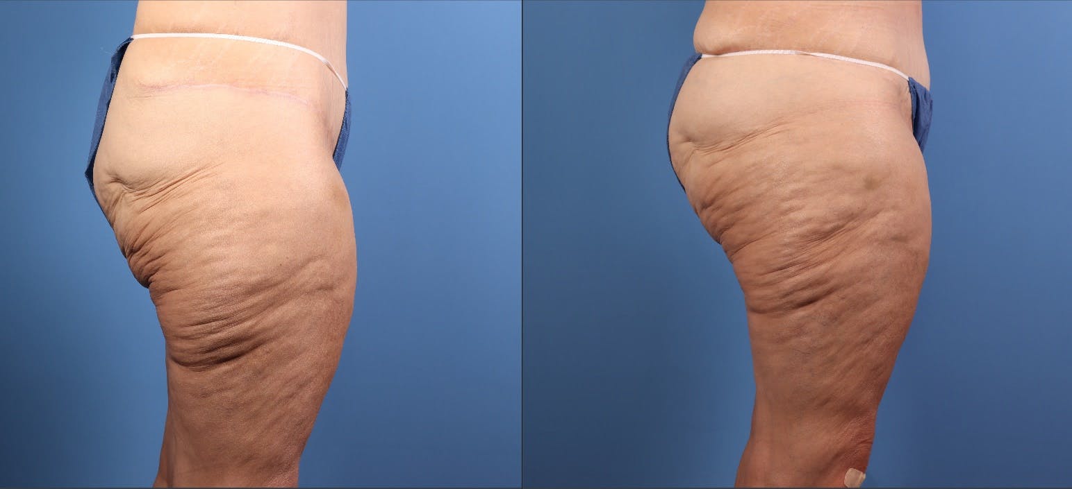Thigh Lift Before & After Gallery - Patient 325856 - Image 4