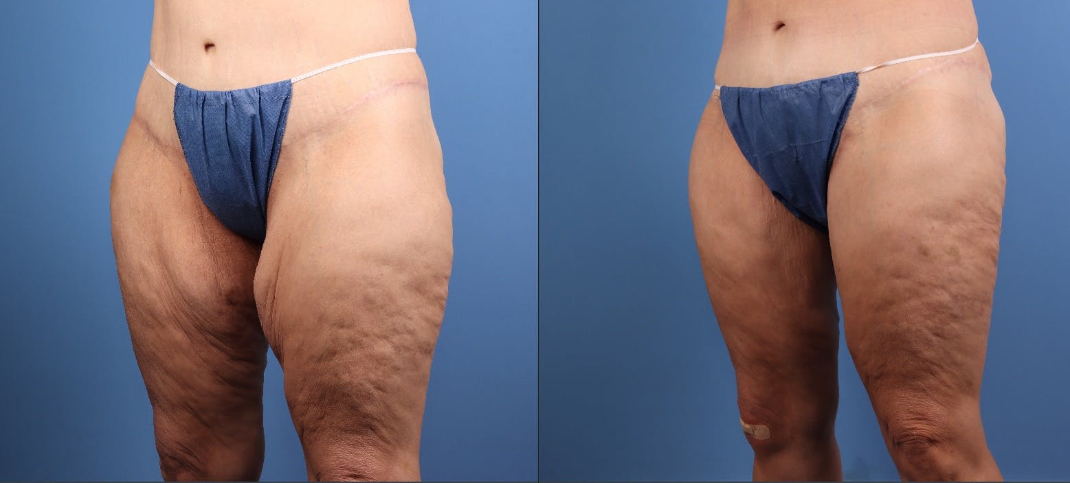 Thigh Lift Before & After Gallery - Patient 325856 - Image 5