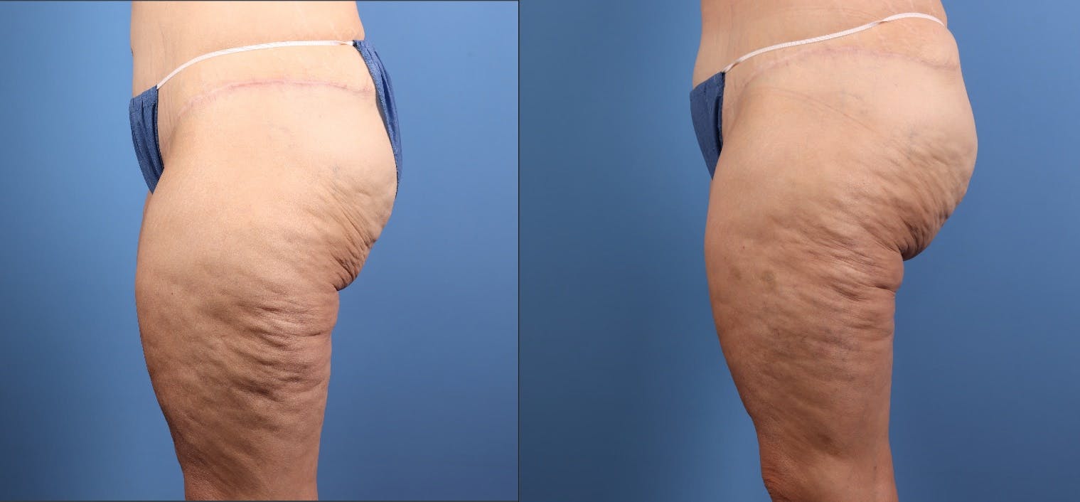 Thigh Lift Before & After Gallery - Patient 325856 - Image 6