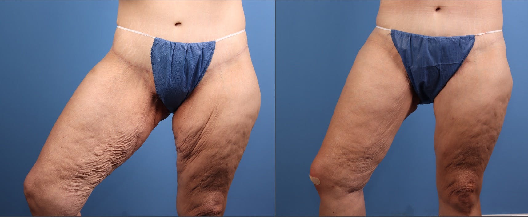 Thigh Lift Before & After Gallery - Patient 325856 - Image 3