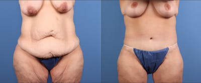 Tummy Tuck Before & After Gallery - Patient 922398 - Image 1