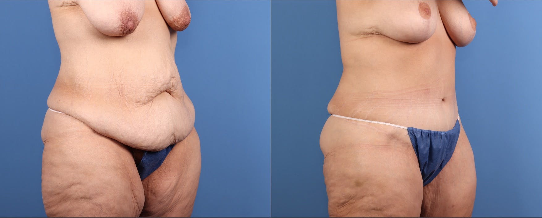 Tummy Tuck Before & After Gallery - Patient 922398 - Image 3