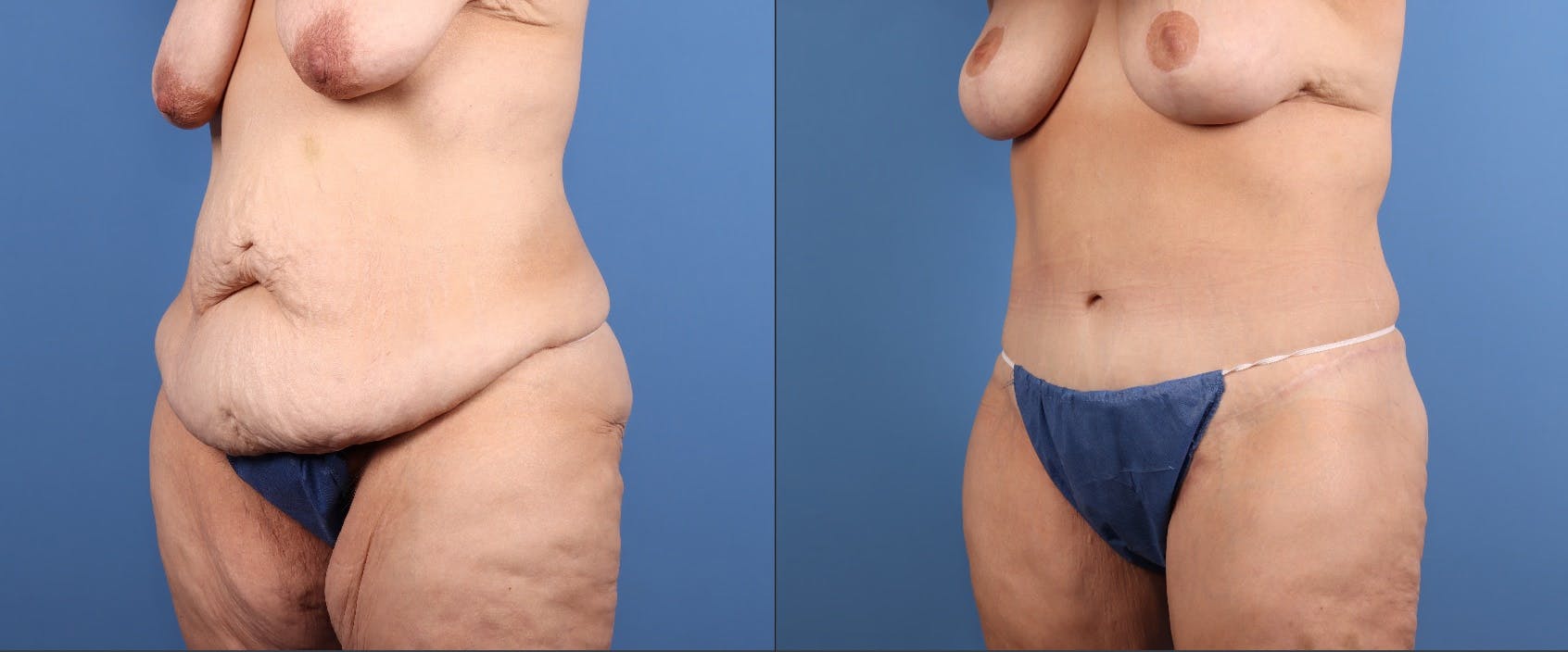 Tummy Tuck Before & After Gallery - Patient 922398 - Image 5