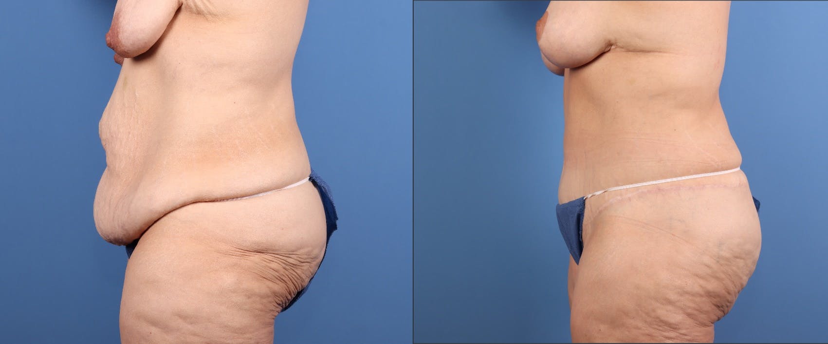Tummy Tuck Before & After Gallery - Patient 922398 - Image 6