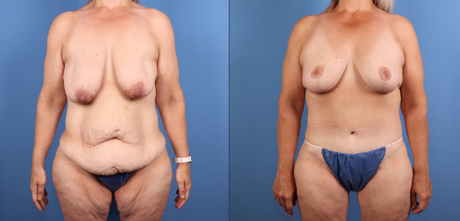 Tummy Tuck Before & After Gallery - Patient 922398 - Image 2