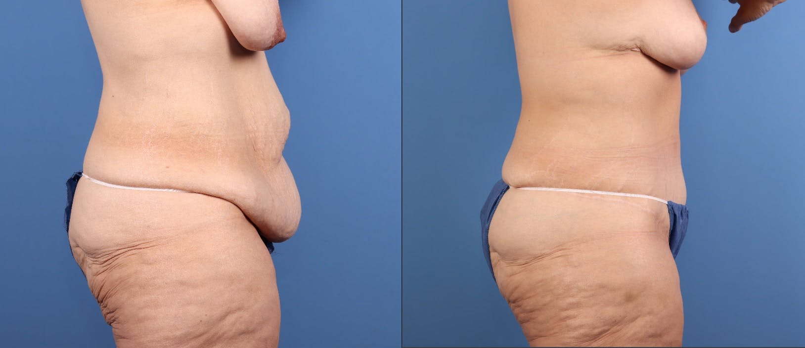 Tummy Tuck Before & After Gallery - Patient 922398 - Image 4