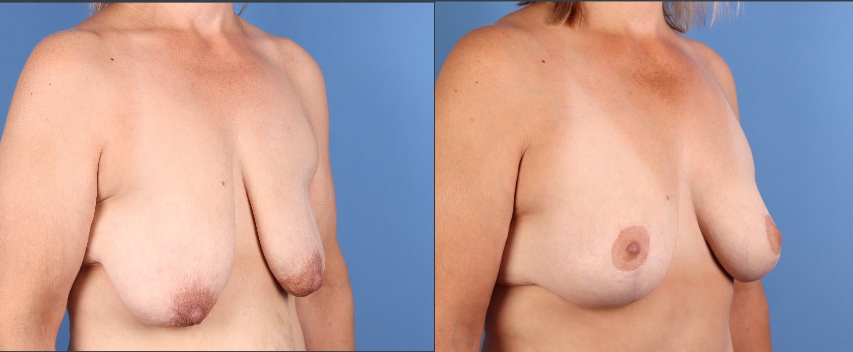 Fat Transfer Breast Augmentation Before & After Gallery - Patient 161538 - Image 2