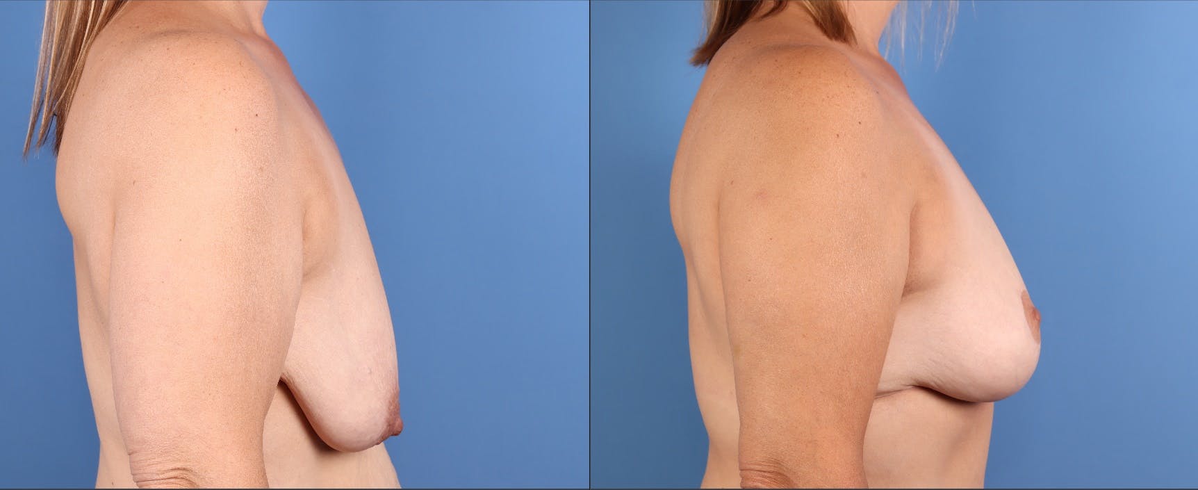 Fat Transfer Breast Augmentation Before & After Gallery - Patient 161538 - Image 3