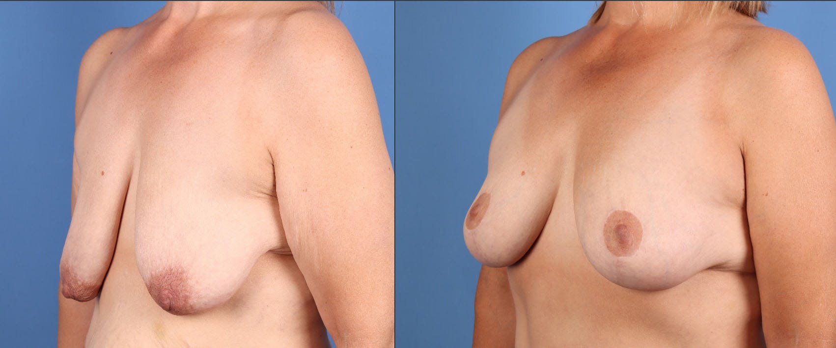 Fat Transfer Breast Augmentation Before & After Gallery - Patient 161538 - Image 4