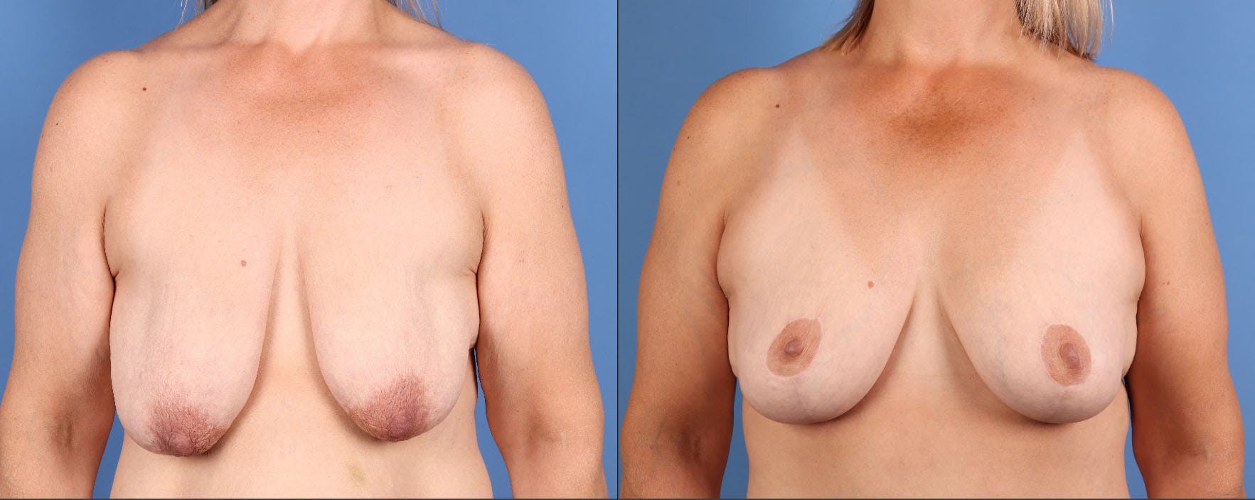 Fat Transfer Breast Augmentation Before & After Gallery - Patient 161538 - Image 1