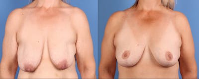 Fat Transfer Breast Augmentation Before & After Gallery - Patient 161538 - Image 1
