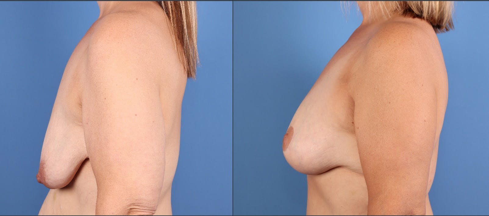 Fat Transfer Breast Augmentation Before & After Gallery - Patient 161538 - Image 5