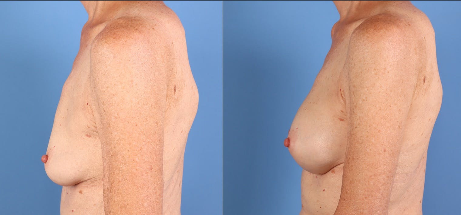Breast Augmentation Before & After Gallery - Patient 392252 - Image 5