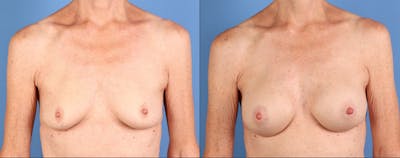 Breast Augmentation Before & After Gallery - Patient 392252 - Image 1