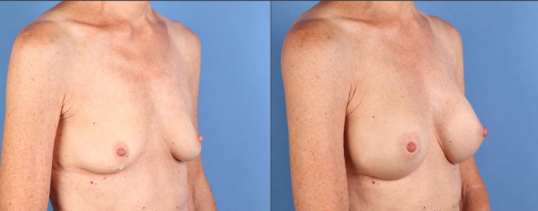 Breast Augmentation Before & After Gallery - Patient 392252 - Image 2
