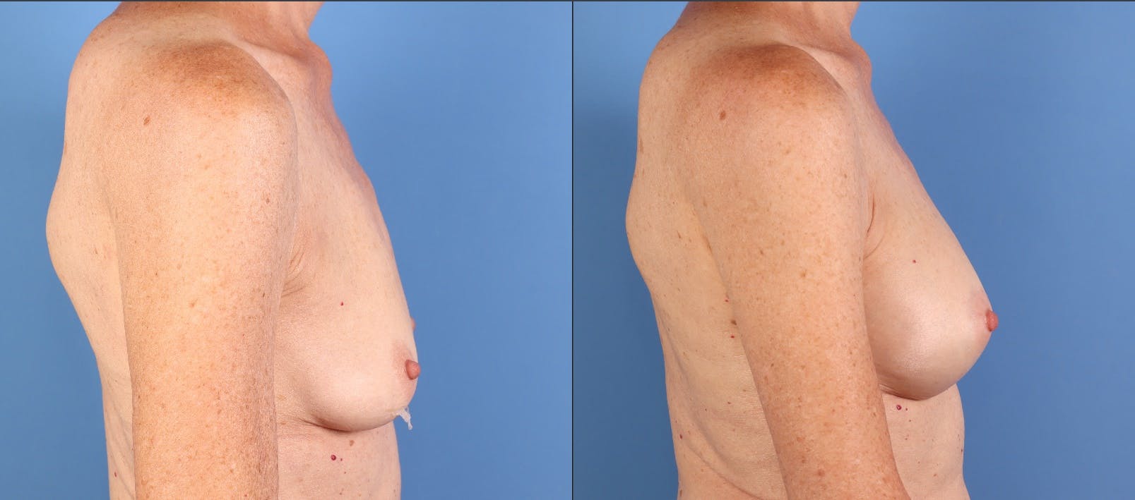 Breast Augmentation Before & After Gallery - Patient 392252 - Image 3
