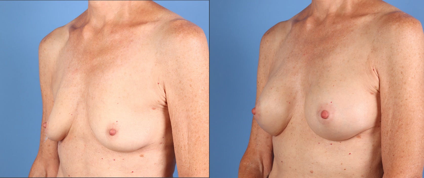 Breast Augmentation Before & After Gallery - Patient 392252 - Image 4