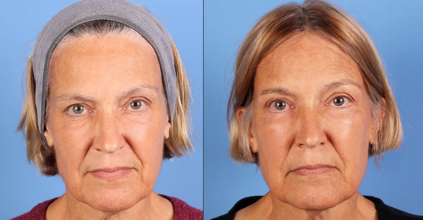 Eyelid Surgery (Upper & Lower Blepharoplasty) Before & After Gallery - Patient 623793 - Image 1