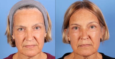 Eyelid Surgery (Upper & Lower Blepharoplasty) Before & After Gallery - Patient 623793 - Image 1