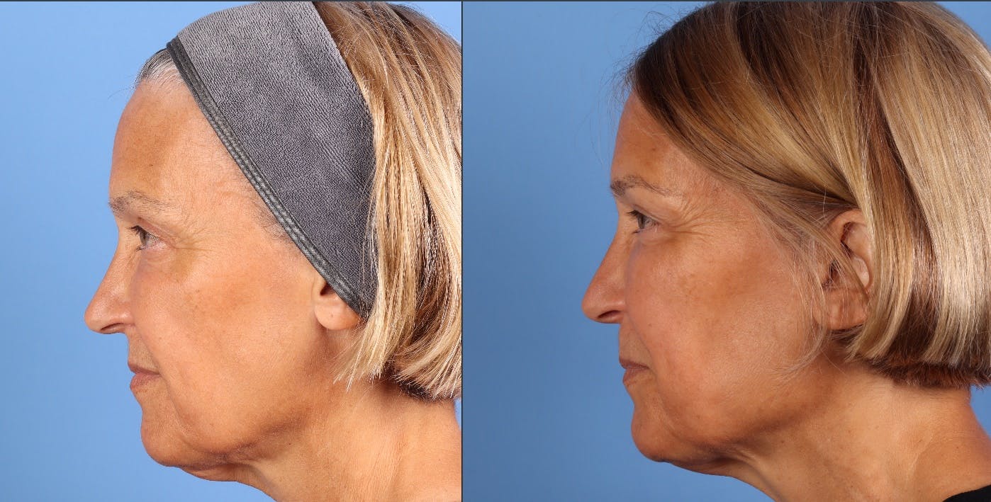 Eyelid Surgery (Upper & Lower Blepharoplasty) Before & After Gallery - Patient 623793 - Image 5