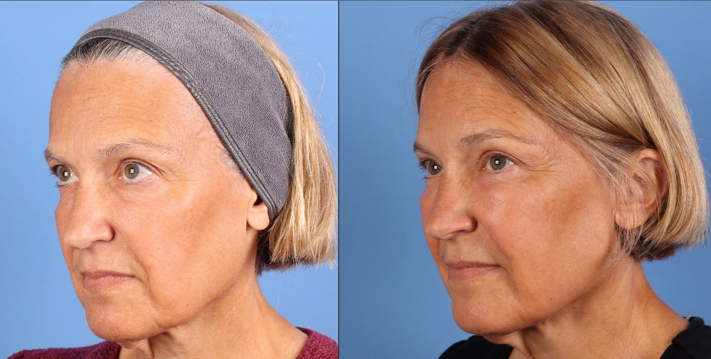 Eyelid Surgery (Upper & Lower Blepharoplasty) Before & After Gallery - Patient 623793 - Image 4