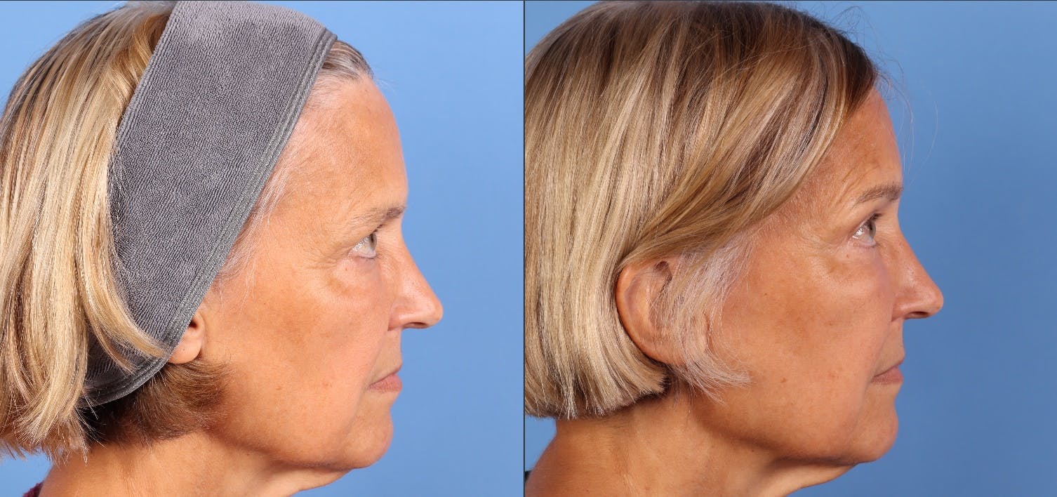 Eyelid Surgery (Upper & Lower Blepharoplasty) Before & After Gallery - Patient 623793 - Image 3