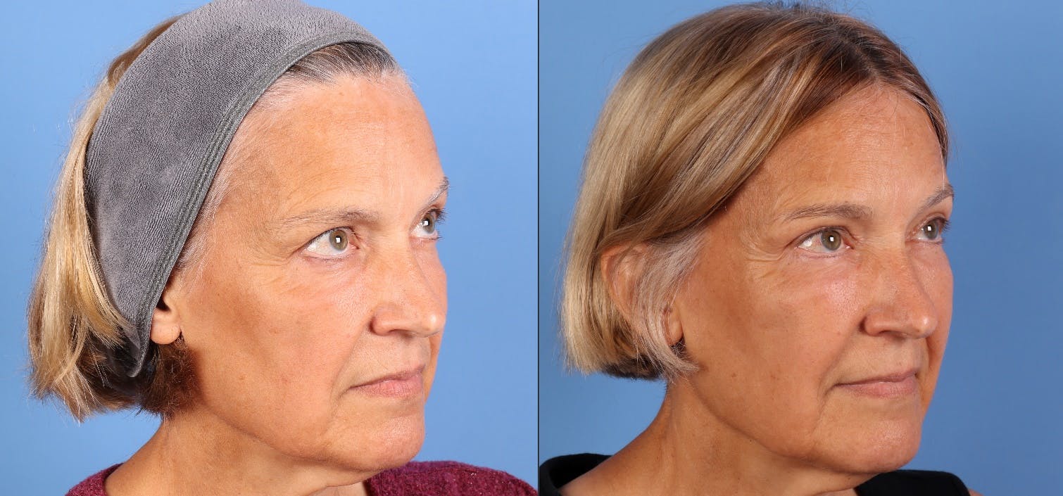 Eyelid Surgery (Upper & Lower Blepharoplasty) Before & After Gallery - Patient 623793 - Image 2
