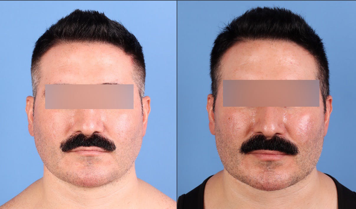 Fat Grafting Before & After Gallery - Patient 494285 - Image 1
