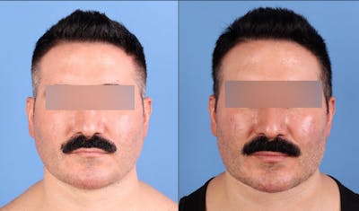 Fat Grafting Before & After Gallery - Patient 494285 - Image 1