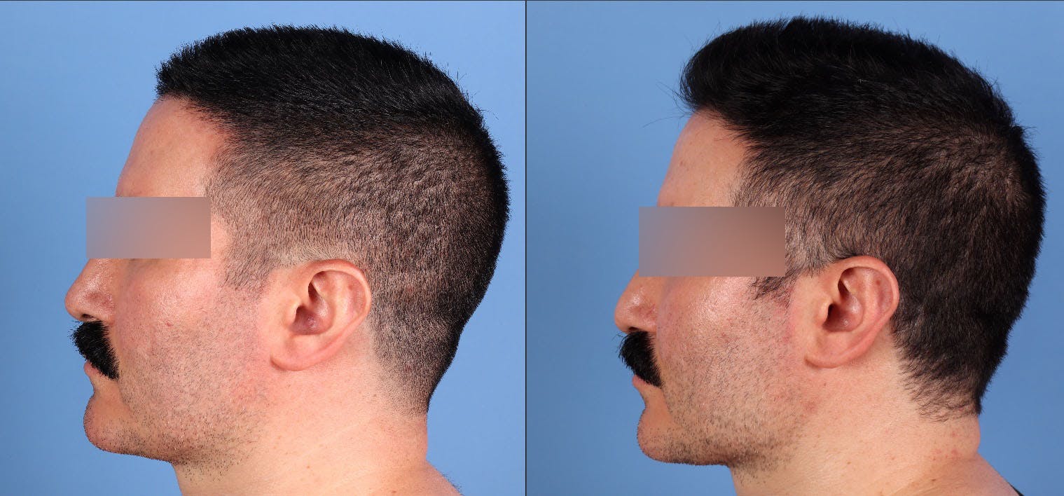 Fat Grafting Before & After Gallery - Patient 494285 - Image 5
