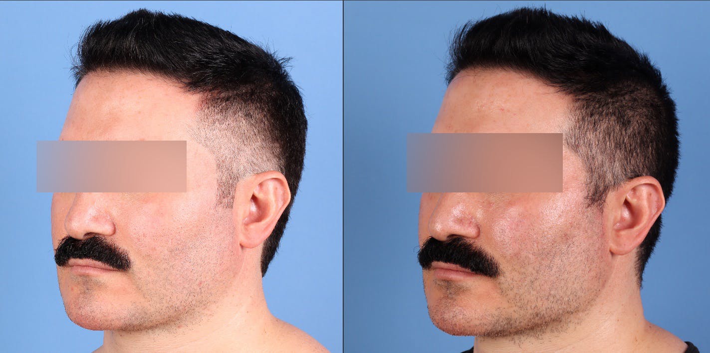 Fat Grafting Before & After Gallery - Patient 494285 - Image 4