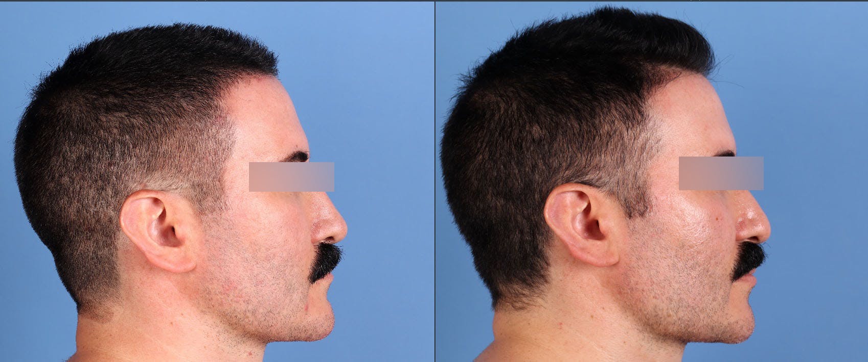 Fat Grafting Before & After Gallery - Patient 494285 - Image 3
