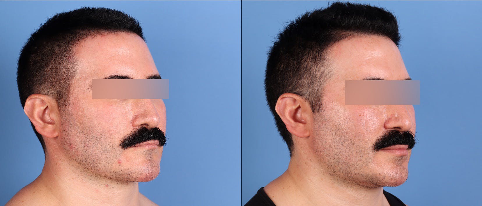 Fat Grafting Before & After Gallery - Patient 494285 - Image 2