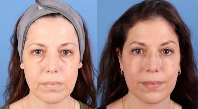 Eyelid Surgery (Upper & Lower Blepharoplasty) Before & After Gallery - Patient 308806 - Image 1