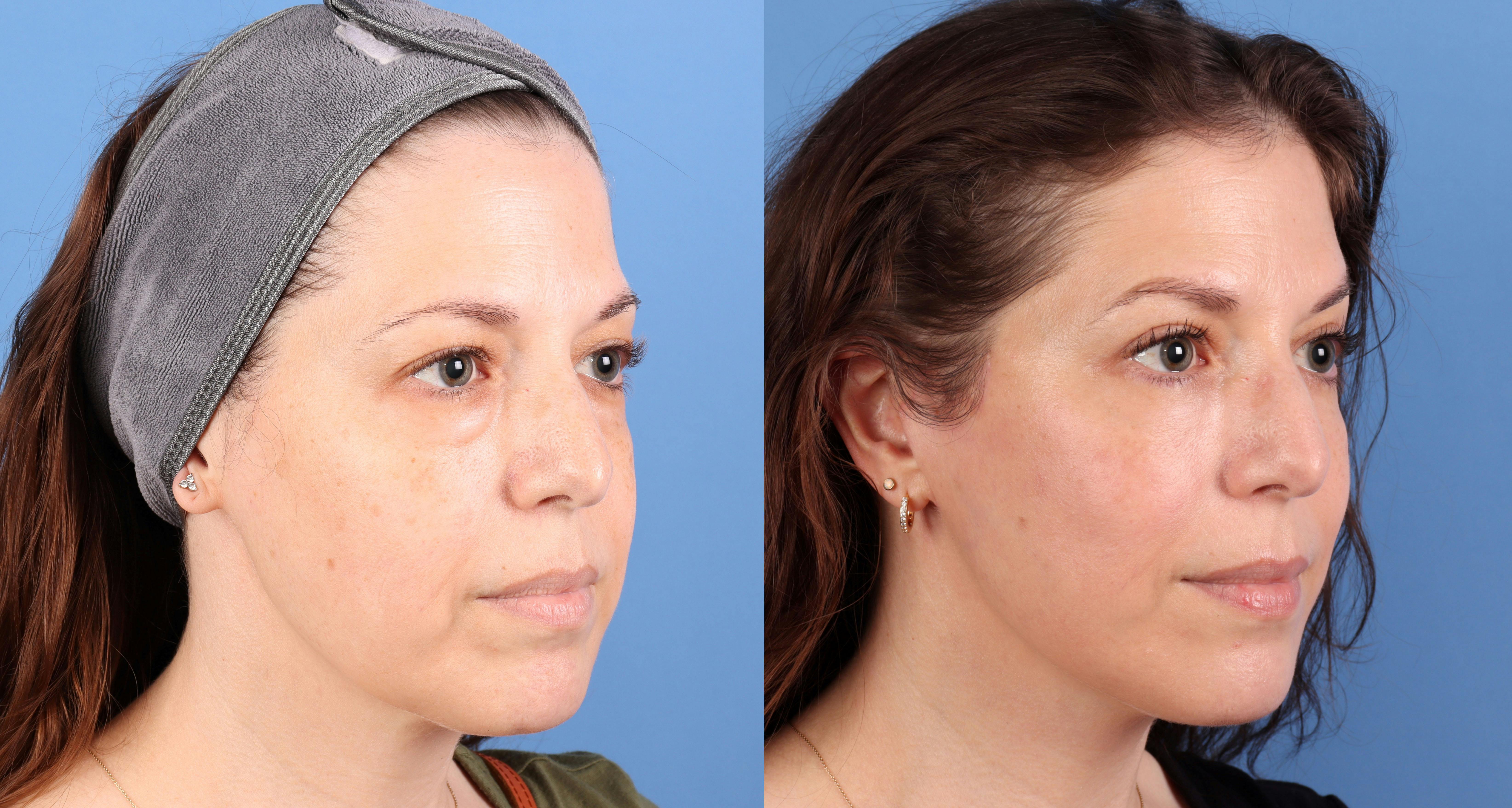 Eyelid Surgery (Upper & Lower Blepharoplasty) Before & After Gallery - Patient 308806 - Image 2