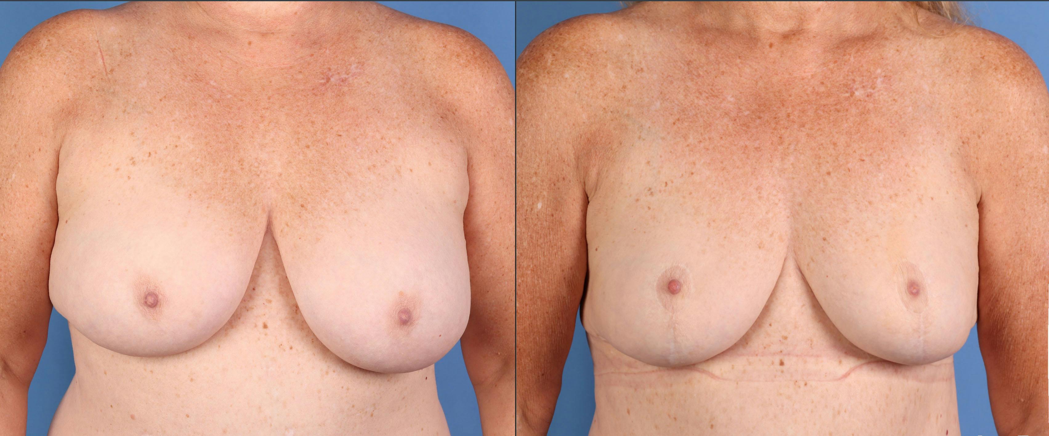 Breast Reduction Before & After Gallery - Patient 351749 - Image 1