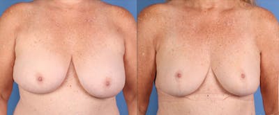 Breast Reduction Before & After Gallery - Patient 351749 - Image 1
